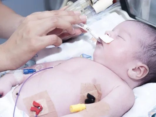 羊水吸入综合征