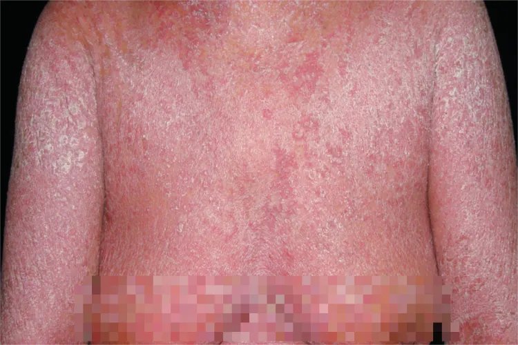 牛皮癣的几种症状图片