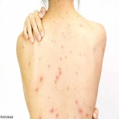 背上长痘是怎么回事
