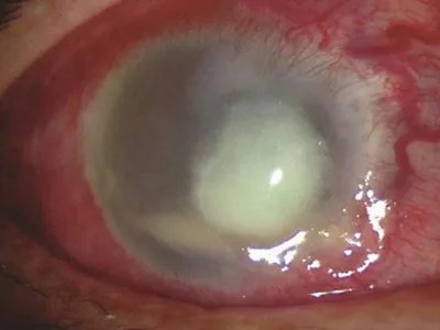 细菌性角膜炎症状图片