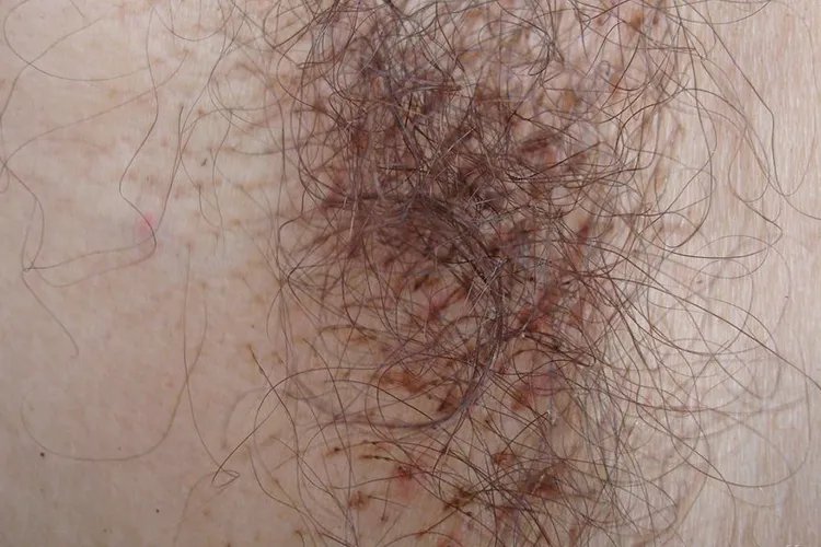 寄生虫性皮肤病图片