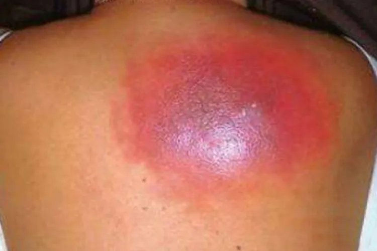 严重毛囊炎图片