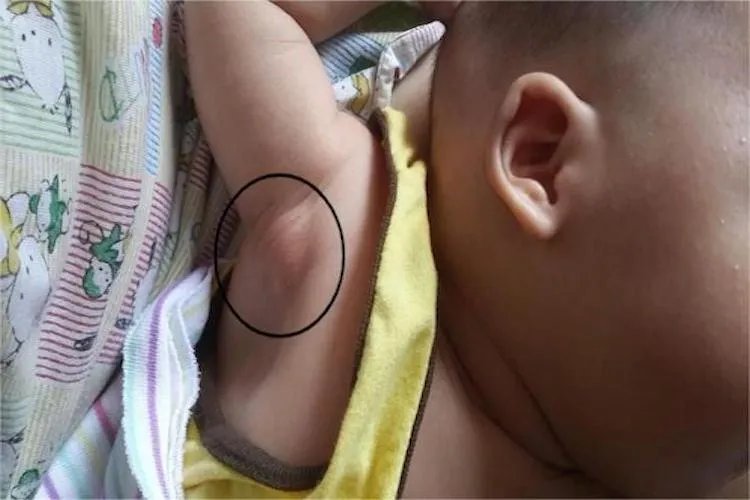卡介苗腋下淋巴结肿大图片