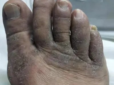 3级手足综合征症状图片