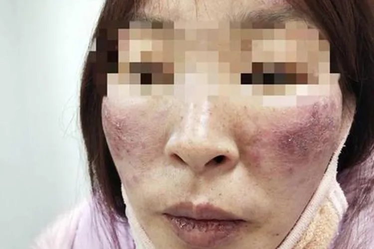 红斑狼疮脸上红斑图片