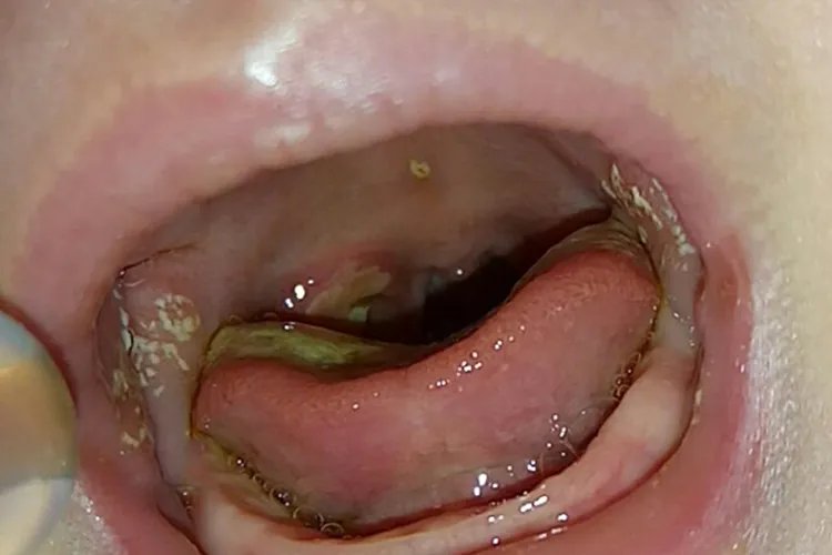 婴儿口疮和鹅口疮有什么区别图片