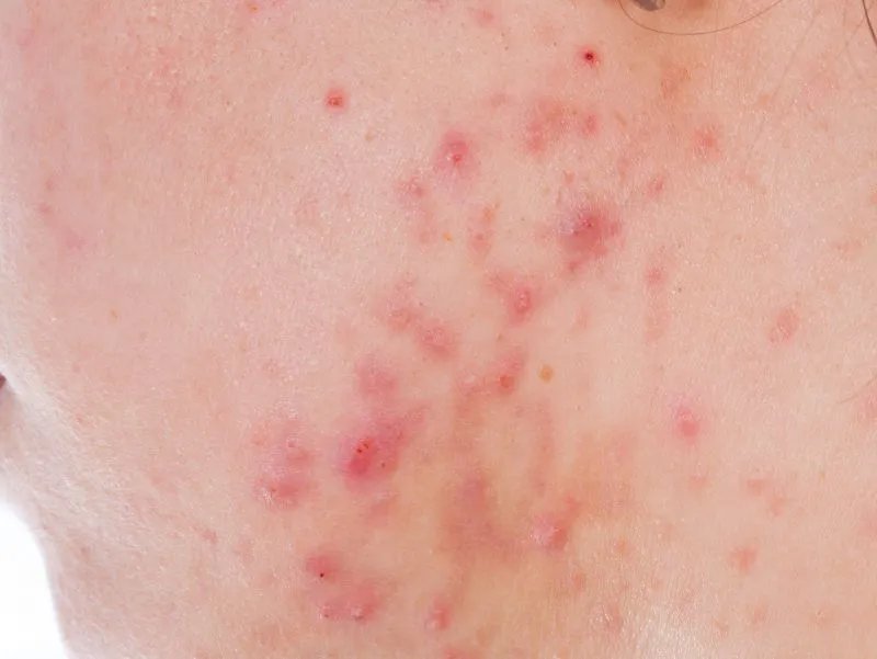 成人痤疮怎么回事