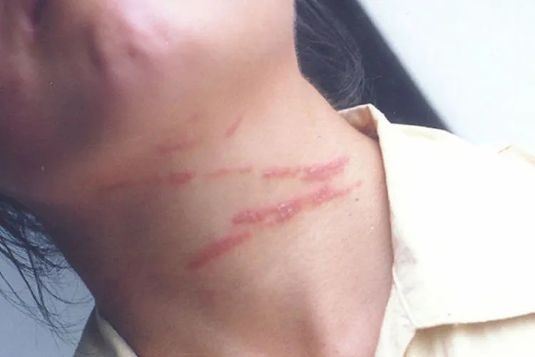 隐翅虫咬人后症状图片