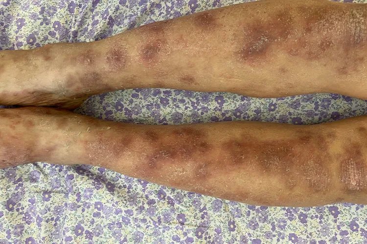 过敏性皮炎湿疹图片