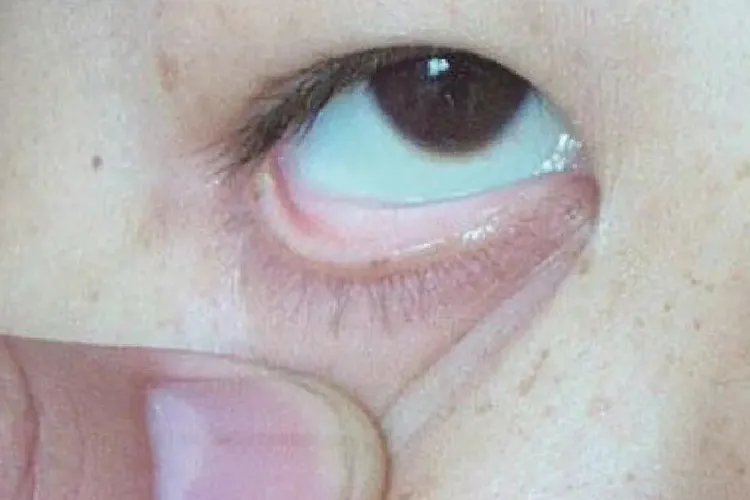 血吸虫病的图片