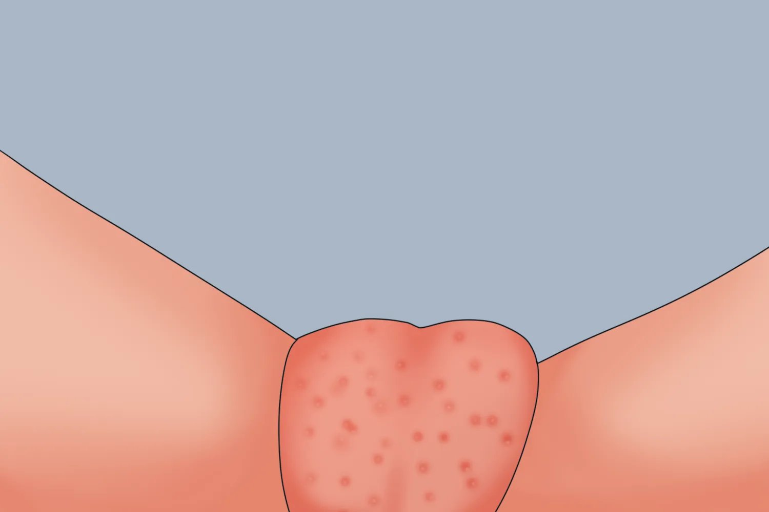 湿疹阴囊症状图片