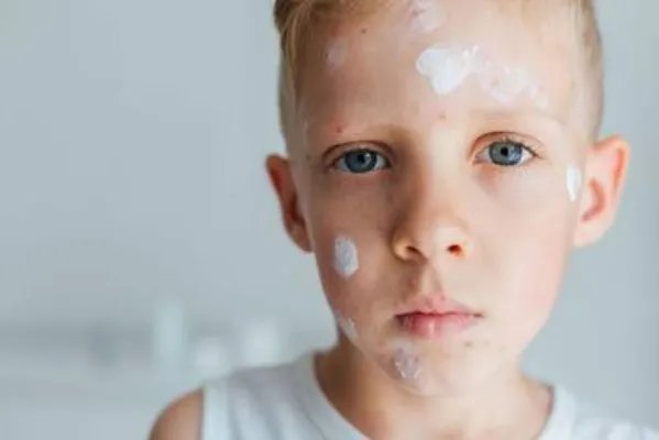 激素过敏性皮炎怎么根治