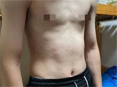 胆碱能性荨麻疹腹部症状图片