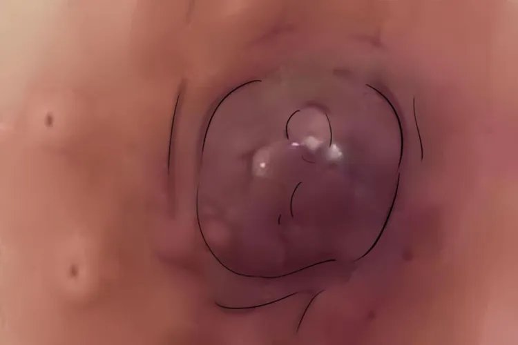 女性乳腺癌早期的图片大全