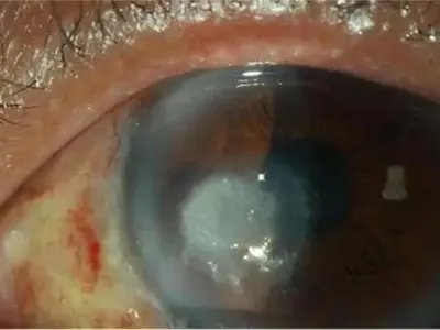 细菌性角膜炎症状图片