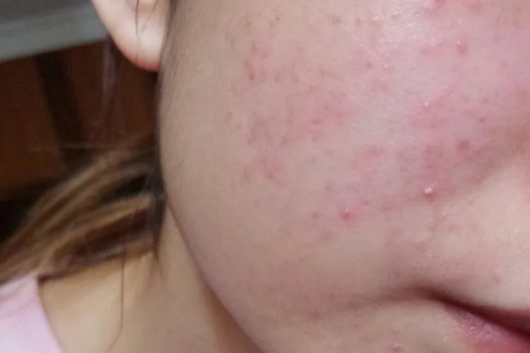 过敏性皮炎湿疹图片