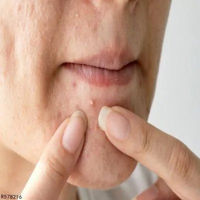 闭合性痤疮的原因有哪些