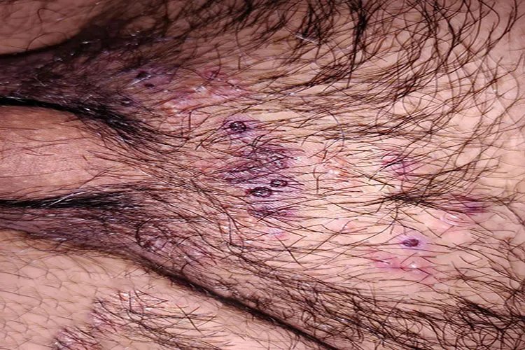 怎么判断是不是水痘图片