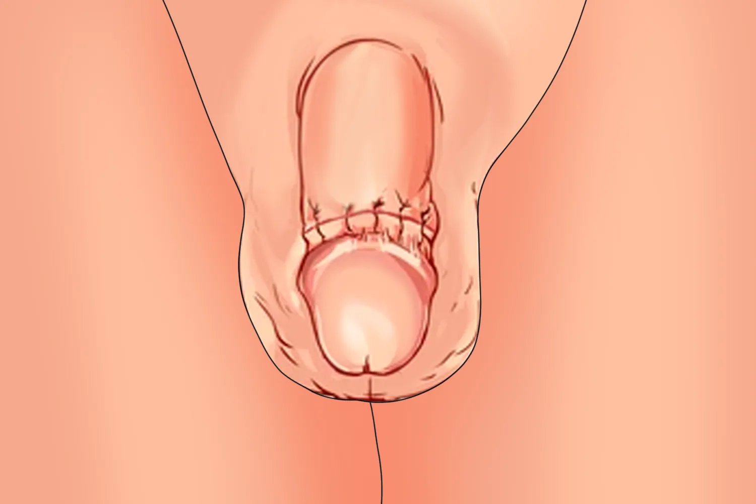 包皮过长术后图片