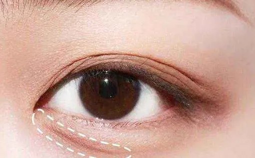 内切祛眼袋的缺点