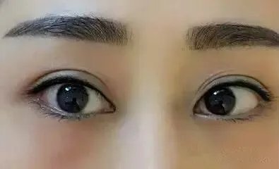 外切去眼袋要多少钱