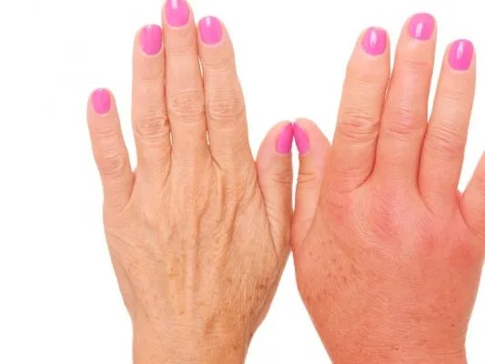 手上皮肤病的原因