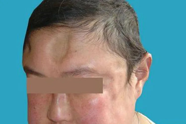 红斑狼疮脸上红斑图片