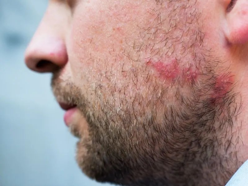 男士祛痘的方法