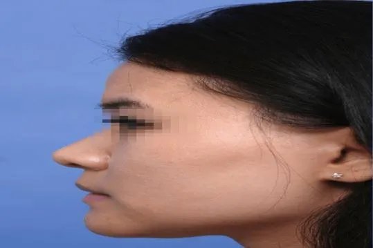 先天性鼻子畸形图片