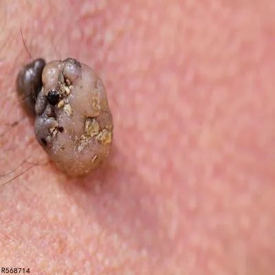 身上长肉瘤是怎么回事 身上长肉瘤警惕两种情况