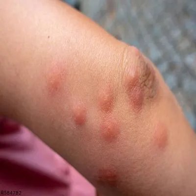 虫咬性皮炎是怎么引起的