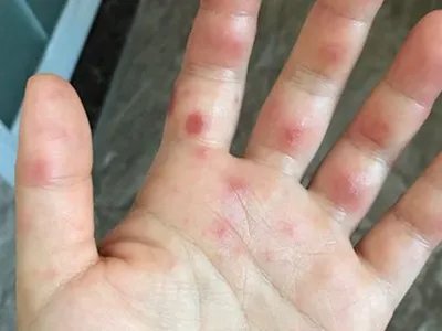 3级手足综合征症状图片