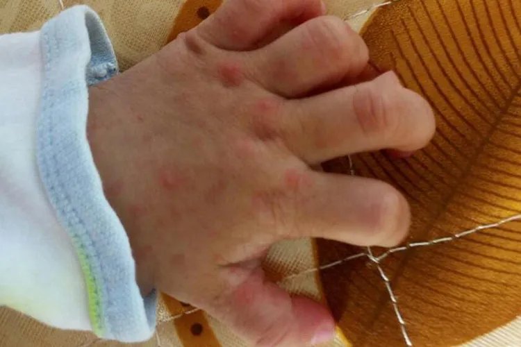 宝宝手足口病初期症状图片