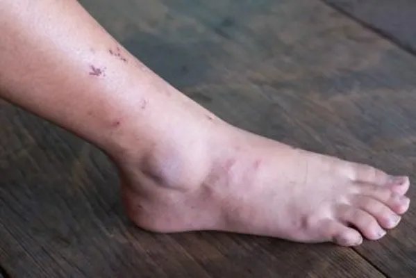 糖尿病足为何会坏疽 告诉你糖尿病足坏疽的严重危害