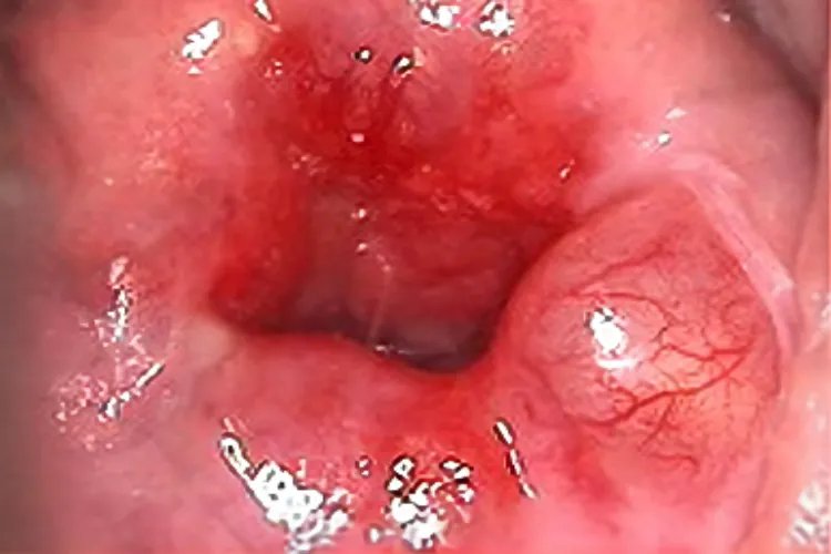 什么是纳囊的图片大全