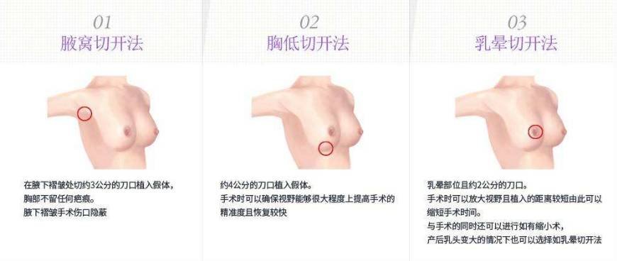 假体隆胸手术方法都有哪些呢？