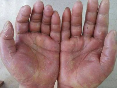 3级手足综合征症状图片