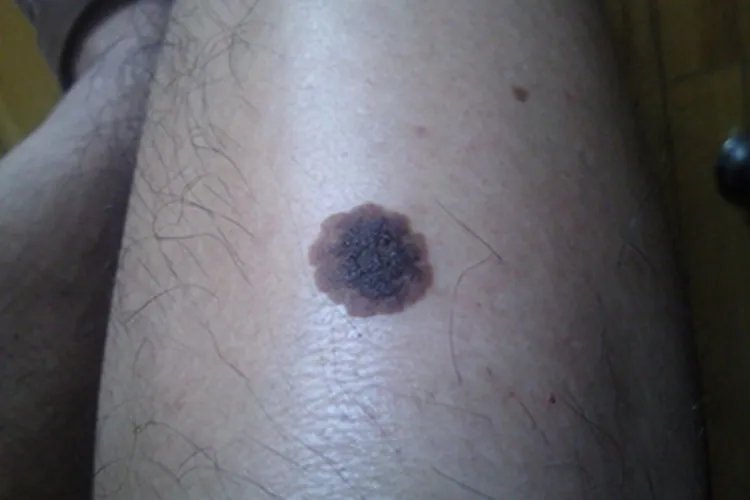 黑素瘤黑斑图片