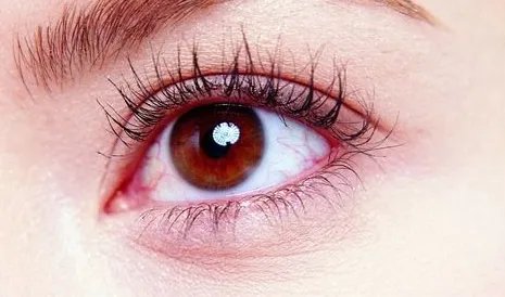 切割双眼皮的价钱