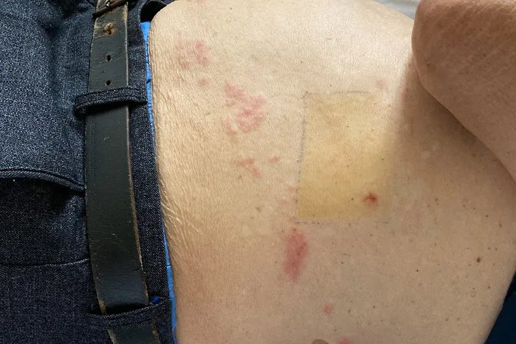 轻度带状疱疹图片