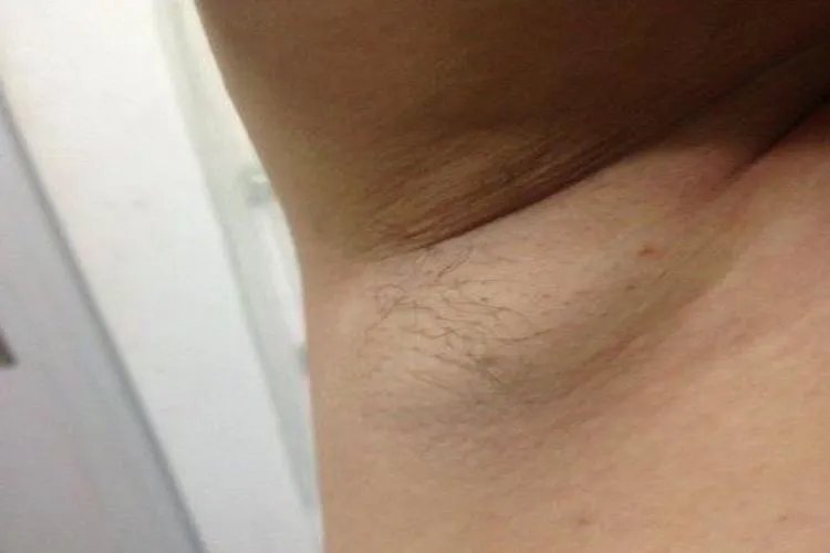 淋巴癌症状有哪些图片