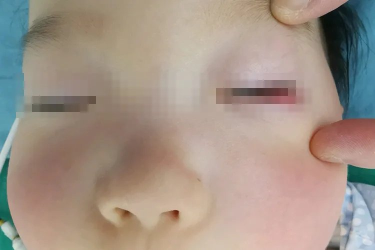 麦粒肿早期图片