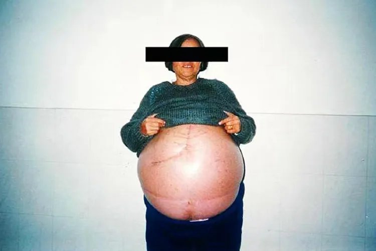 血吸虫病的图片