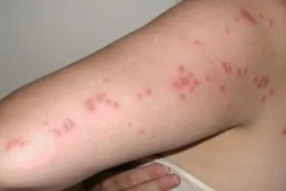 丘疹性荨麻疹长什么样