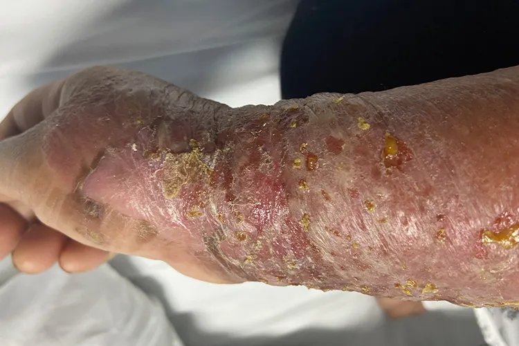 过敏性皮炎湿疹图片