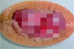 痔疮外痔长什么样图片