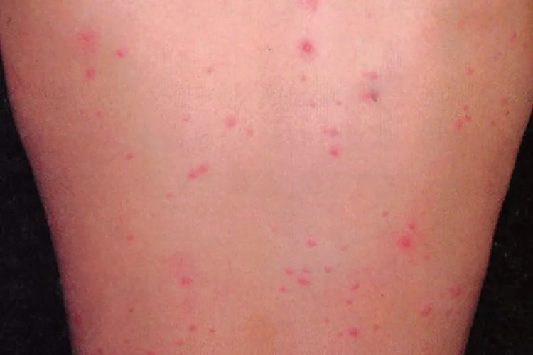 怎么判断是不是水痘图片