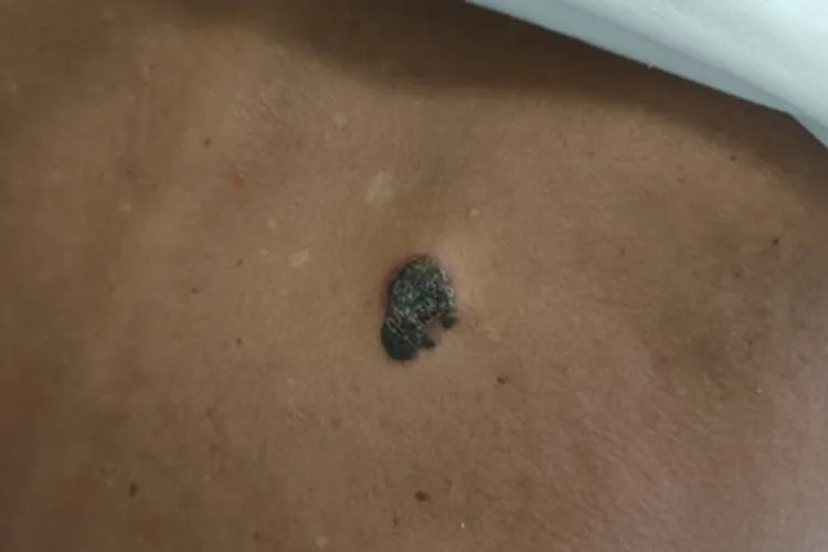 黑素瘤黑斑图片