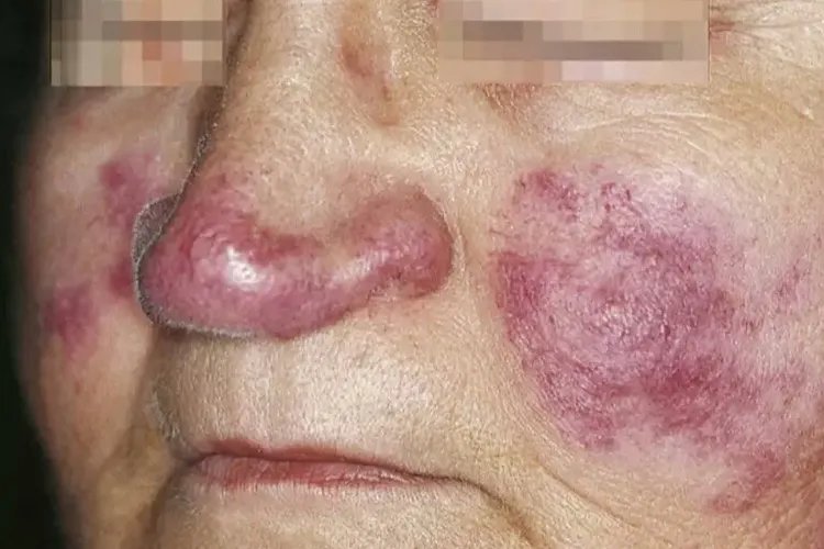 红斑狼疮脸上红斑图片