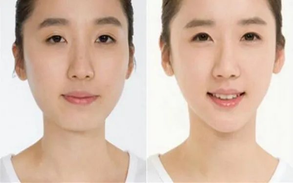 自体脂肪填充下巴多少钱